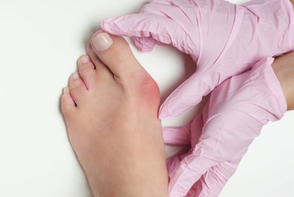 Bunions