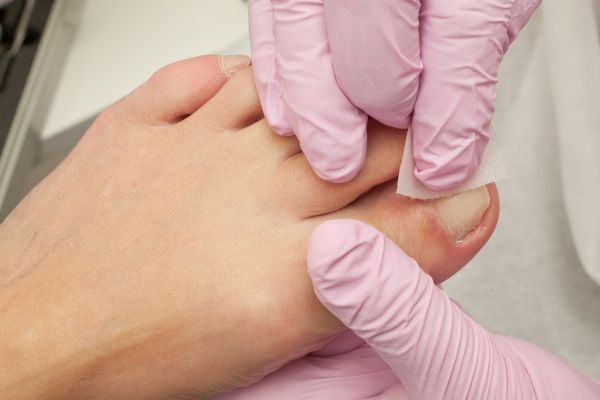 Ingrown Toenails